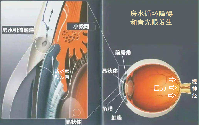 世界青光眼日｜谁更容易得青光眼？来看看“狡猾”的青光眼